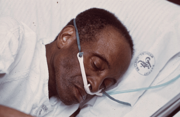 This EPA photo from the early 1970s shows an excoal miner suffering from black lung LeRoy WoodsonNational Archives and Records Administration