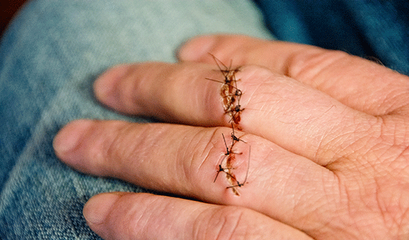 The conditions that lead to a serious hand injury easily can cause an amputation and OSHA has updated its National Emphasis Program NEP on Amputations due to the high numbers of amputations experienced by workers