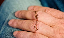 The conditions that lead to a serious hand injury easily can cause an amputation and OSHA has updated its National Emphasis Program NEP on Amputations due to the high numbers of amputations experienced by workers The conditions that lead to a serious hand injury easily can cause an amputation and OSHA has updated its National Emphasis Program NEP on Amputations due to the high numbers of amputations experienced by workers