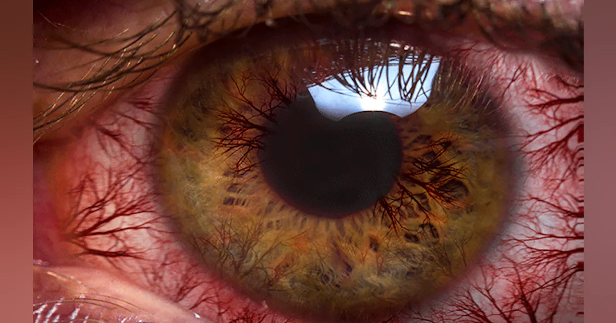 Technology Eye Rot Most Americans Experience Digital Eye Strain from Overexposure to ...
