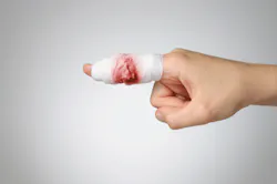 According to OSHA Olympia Chimney Supply Inc employees have suffered crushed fingers and amputation of multiple fingertips and entire fingers