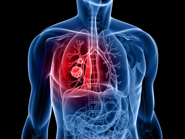 Nemak USA Inc. Workers Diagnosed with Lung Disease EHS Today