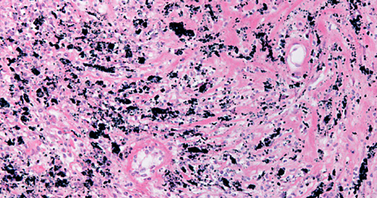 black-lung-silicosis