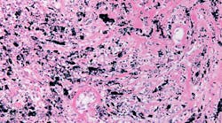 Light micrograph showing a human lung affected by a severe silicosis. The normal structure of parenchyma has disappeared and has been replaced by fibrotic areas and deposits of anthracotic pigment.