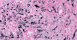 black-lung-silicosis black-lung-silicosis