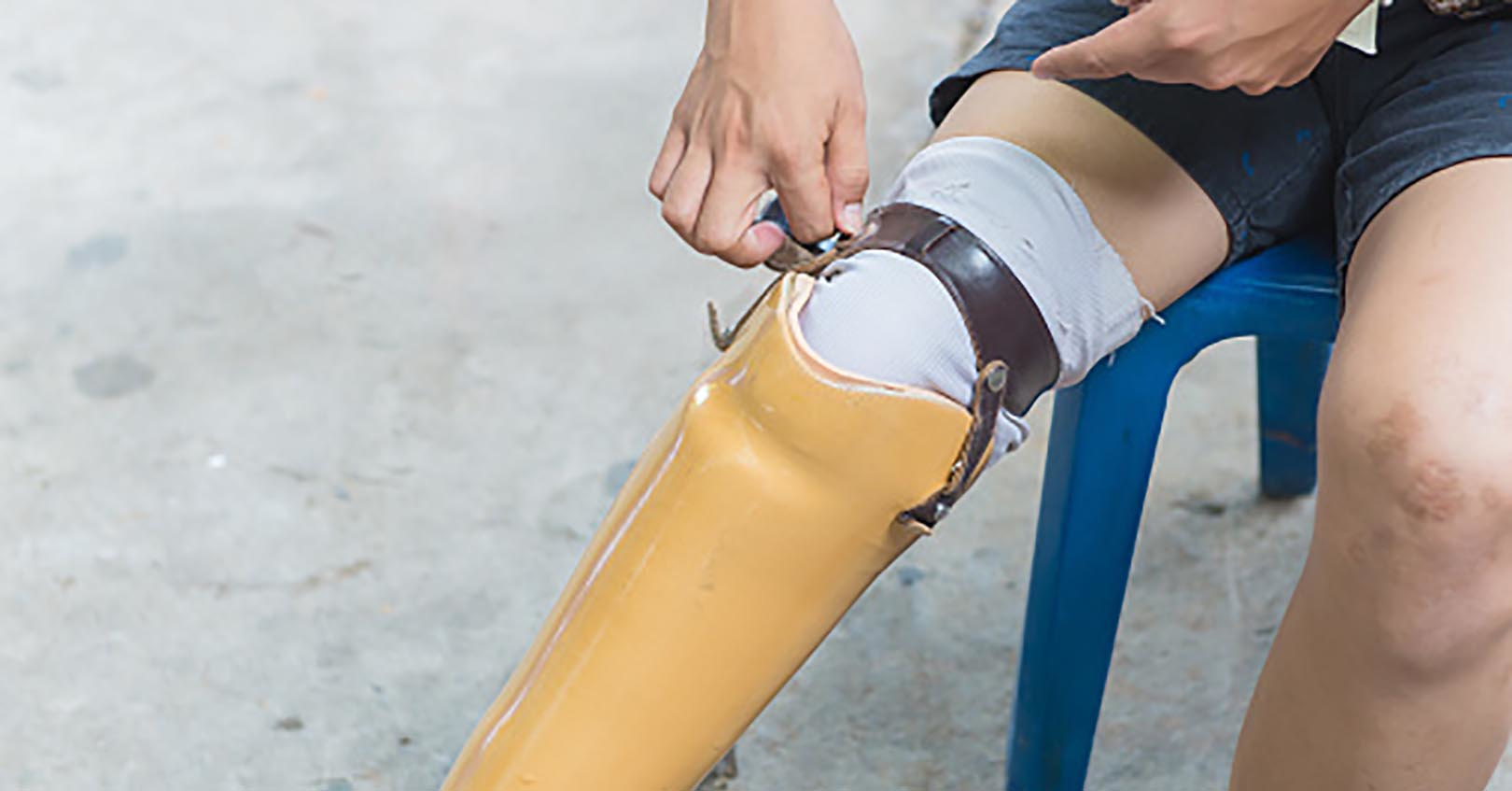 Amputation 5e28b297b3239