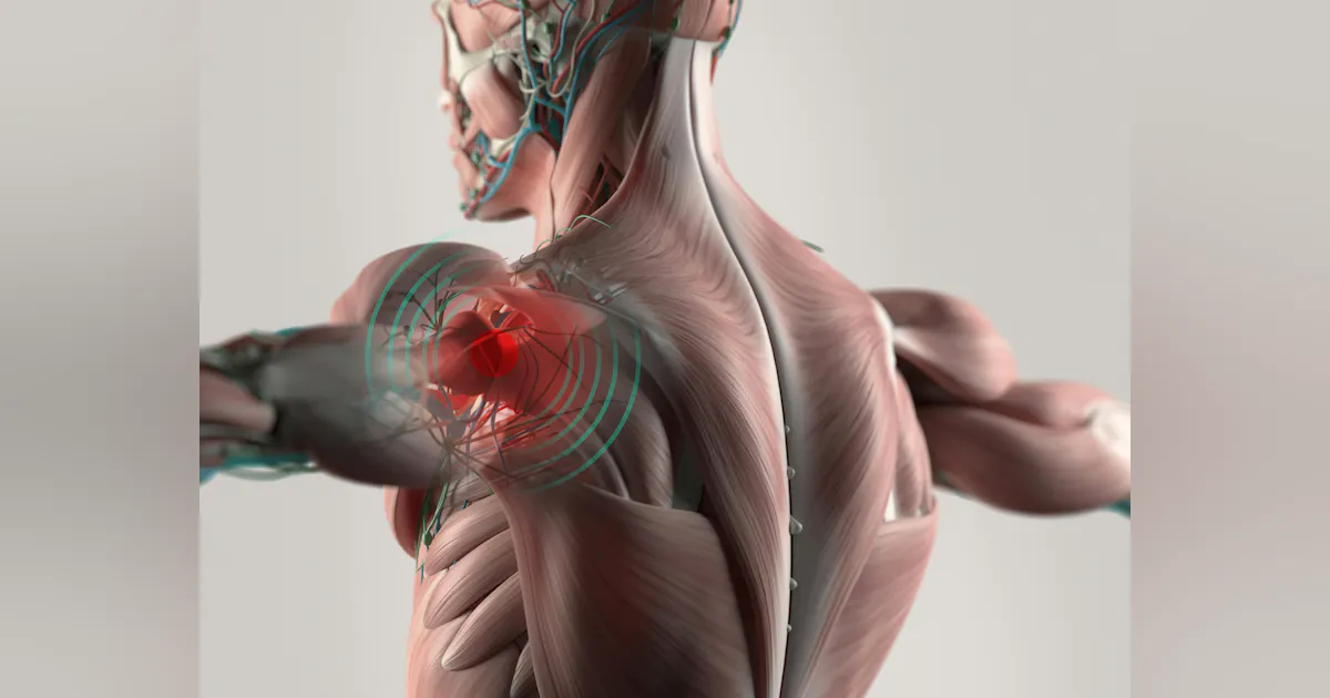 Back Injuries Msd NSC: Progress on Preventing MSD Injuries | EHS Today